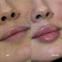 Контурная пластика губ